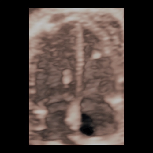 Ecocardiografia fetale 3D