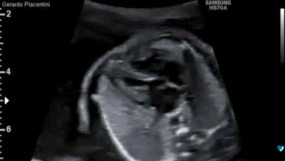 Ecocardiografia fetale - 22 settimane